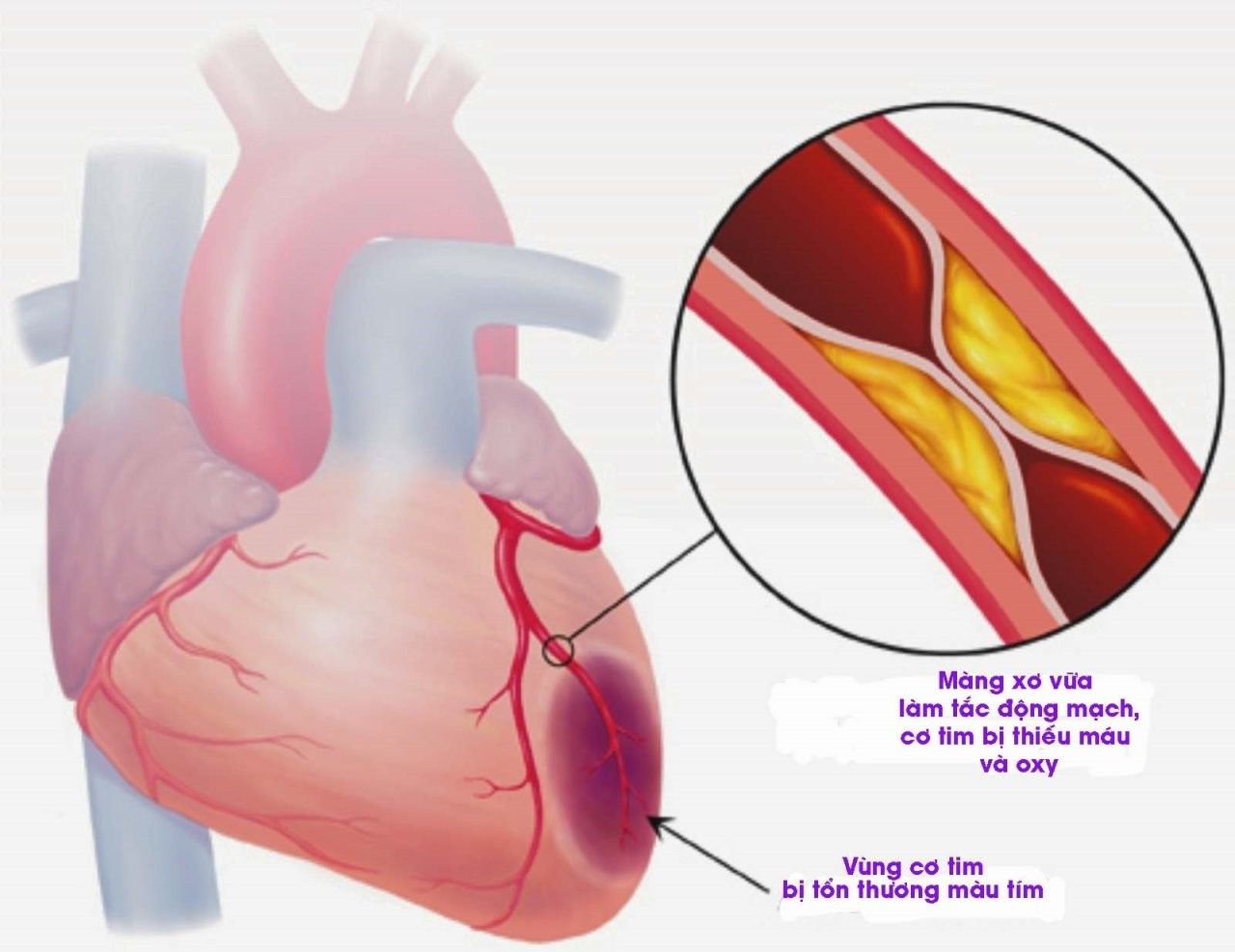 Sơ cứu đúng cách người bị nhồi máu cơ tim