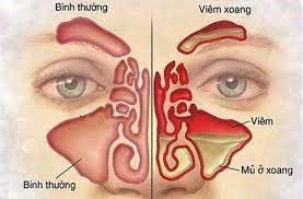 Phòng tránh viêm xoang mùa lạnh