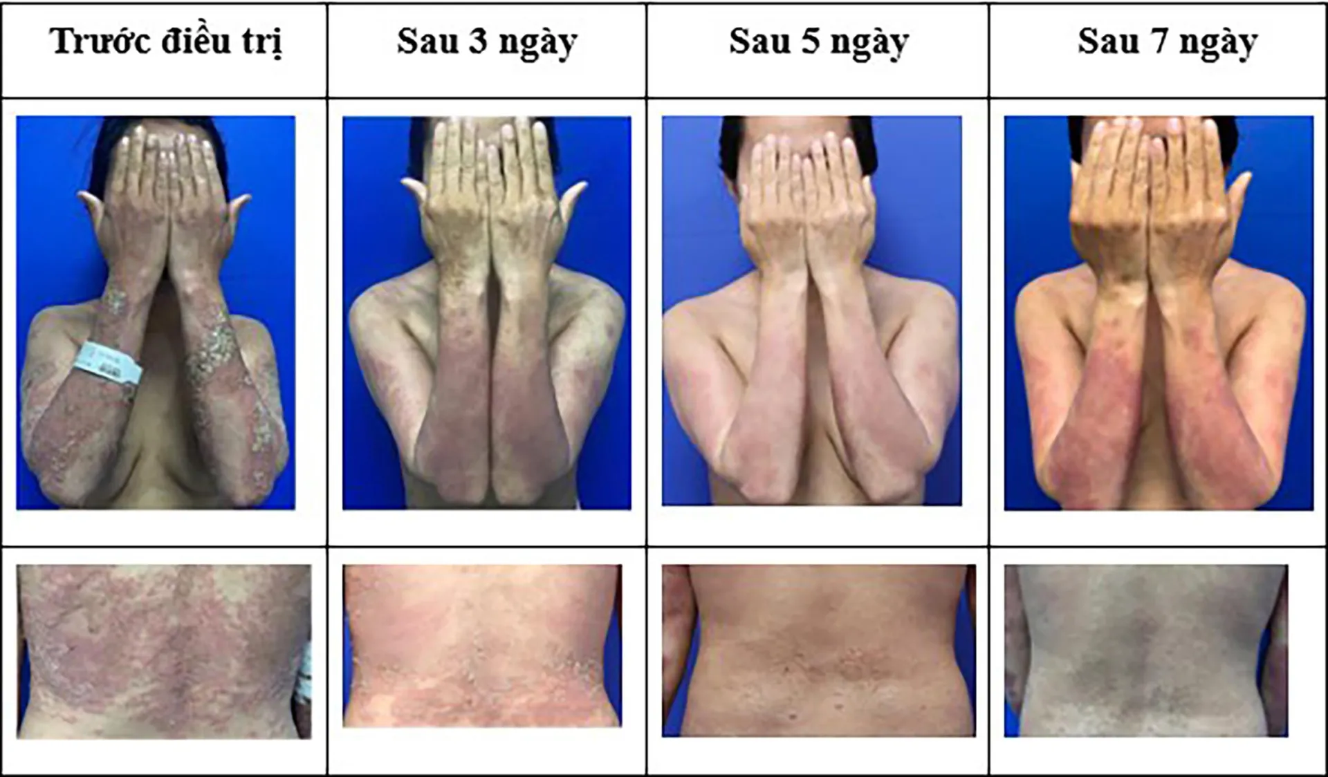 Spesolimab - Niềm hi vọng mới cho người bệnh vảy nến thể mủ toàn thân