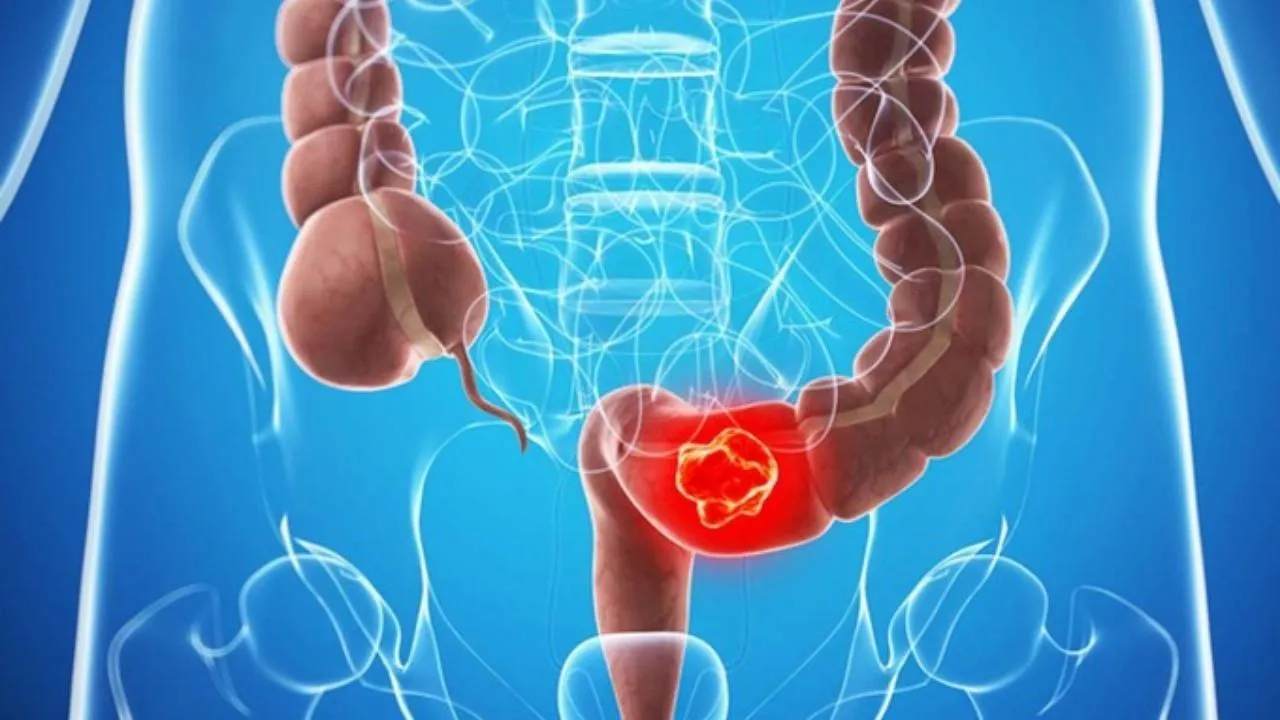 Từ polyp đến ung thư: Hành trình 10 năm có thể ngăn chặn