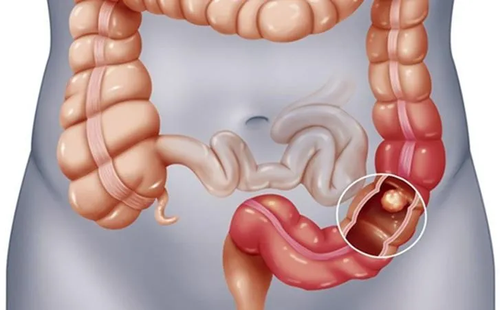 Người thân mắc ung thư tiêu hóa: Gia đình cần làm gì?