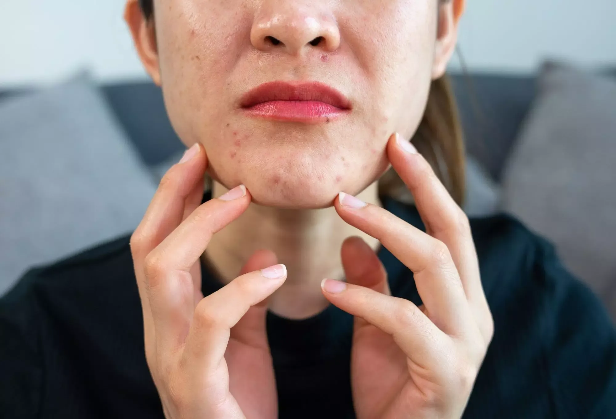 Nhiều người uống kẽm trị mụn nhưng mắc sai lầm này: Càng dùng càng hại sức khỏe