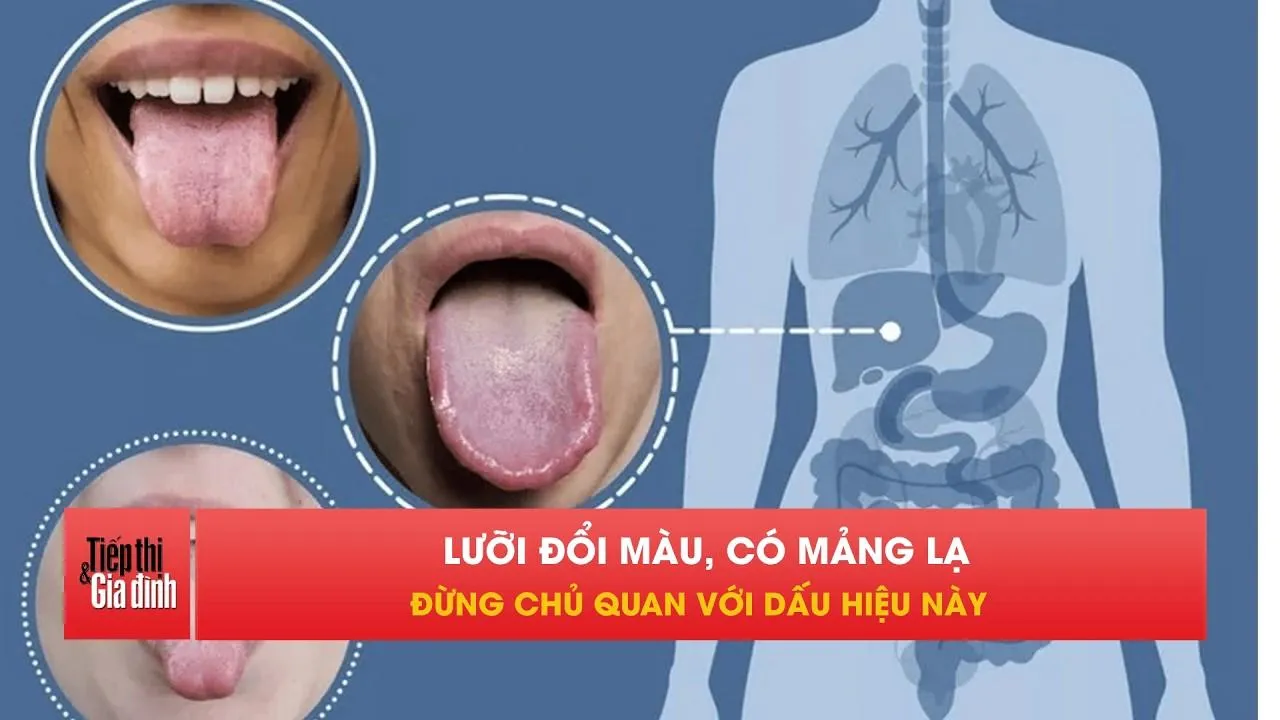 Nhìn lưỡi có thể biết cơ thể đang gặp vấn đề gì?