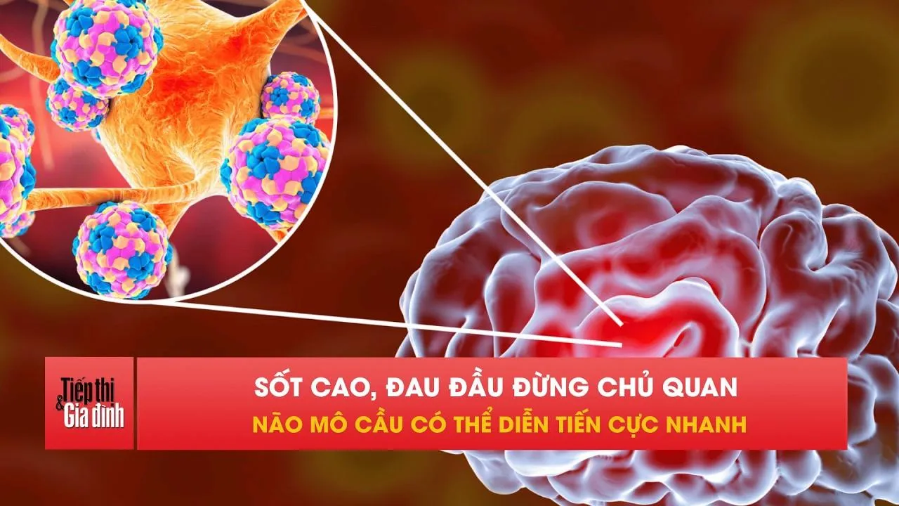 Não mô cầu mùa hè dễ bùng phát, trẻ có thể trở nặng rất nhanh