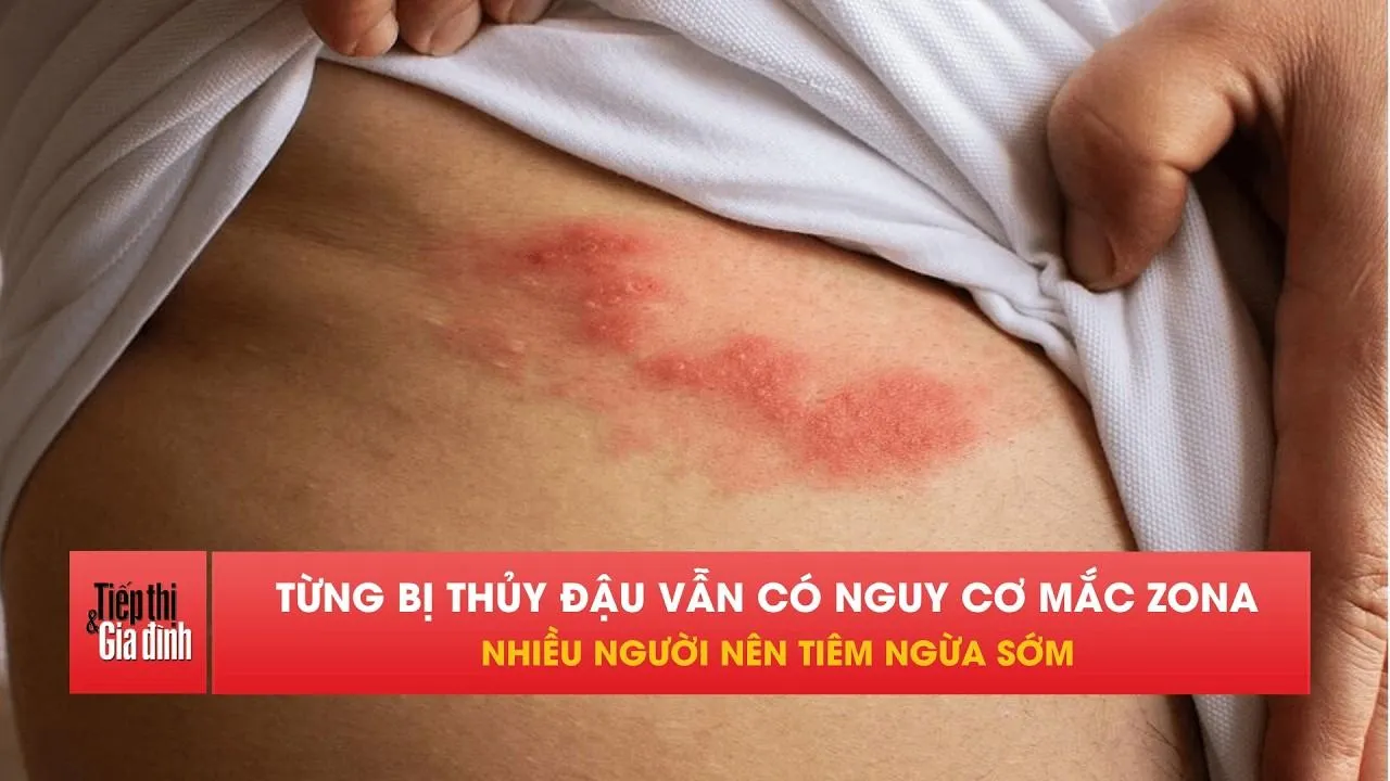 Zona thần kinh không chỉ đau rát, biến chứng có thể kéo dài