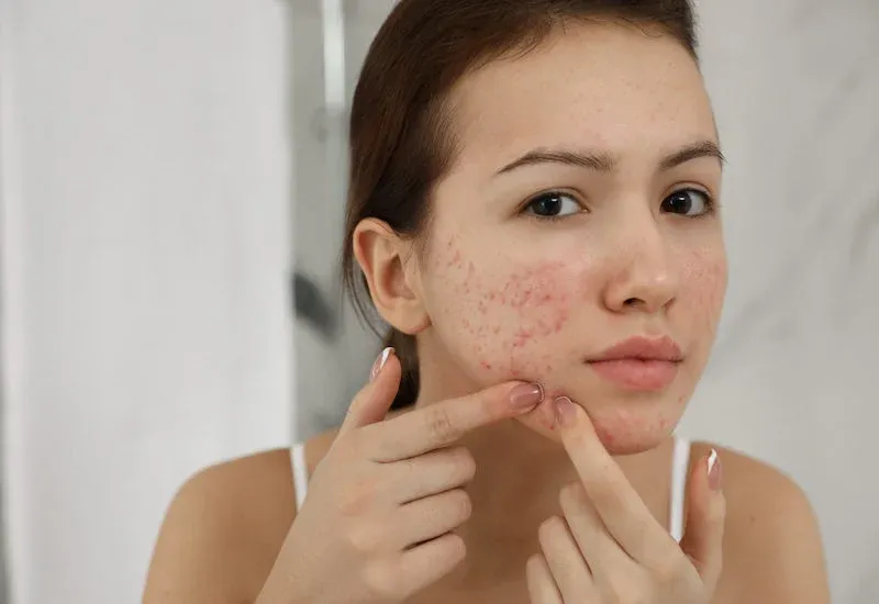Muốn ngăn mụn tái phát? Đừng bỏ qua 6 bước chăm sóc da quan trọng này