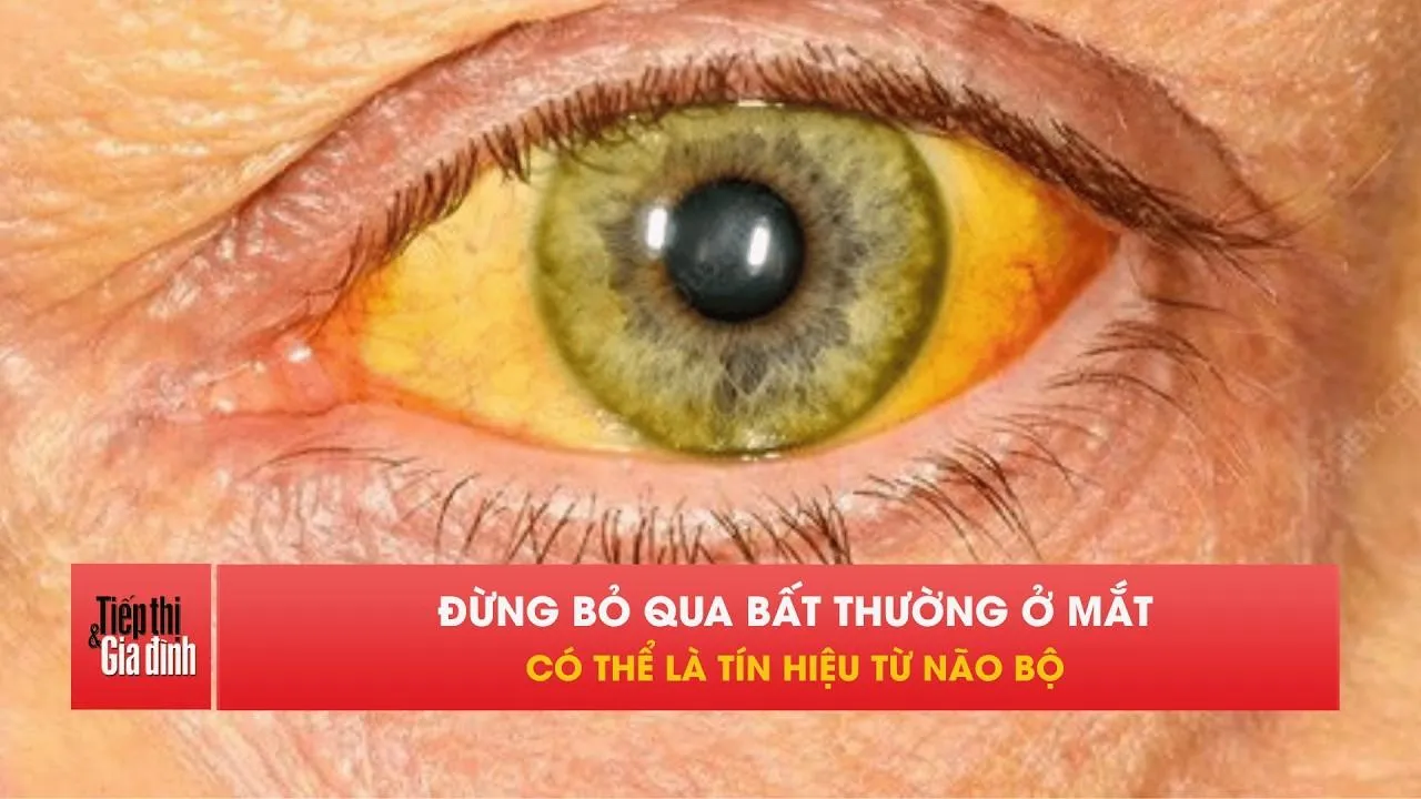5 dấu hiệu ở mắt có thể cảnh báo não bộ đang gặp vấn đề