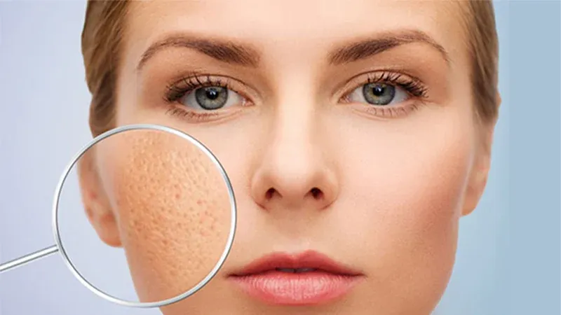 Da mặt bị rỗ có thể cải thiện tại nhà không? Chuyên gia chỉ những cách nên áp dụng
