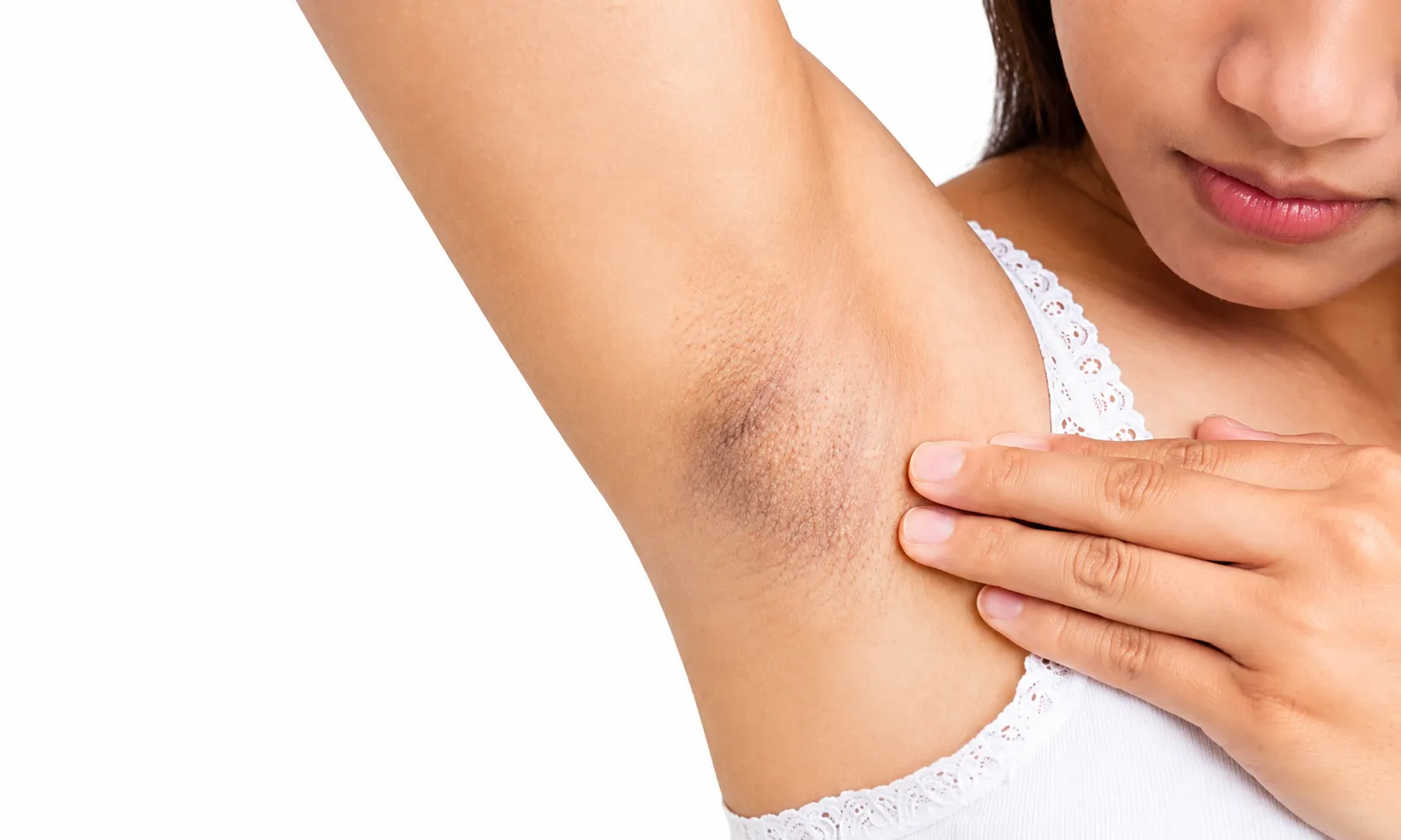 4 nguyên nhân khiến vùng da dưới cánh tay ngày càng thâm sạm, nhiều người mắc phải mà không biết