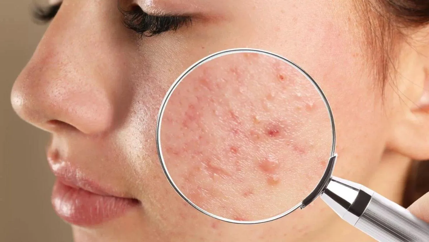 Da dầu mãi không hết mụn? Có thể bạn đang lặp lại 4 thói quen này mỗi ngày