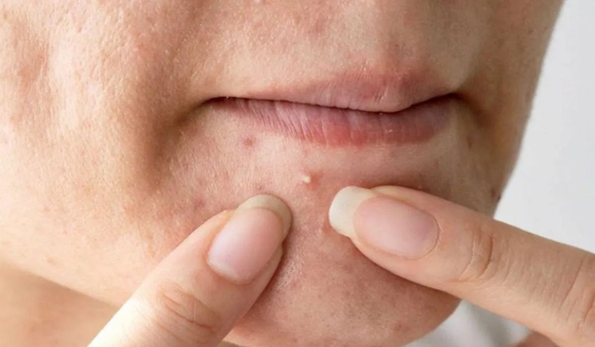 Mẹo chăm sóc da sau khi nặn mụn đúng cách: 5 bước giúp da nhanh lành, hạn chế thâm sẹo