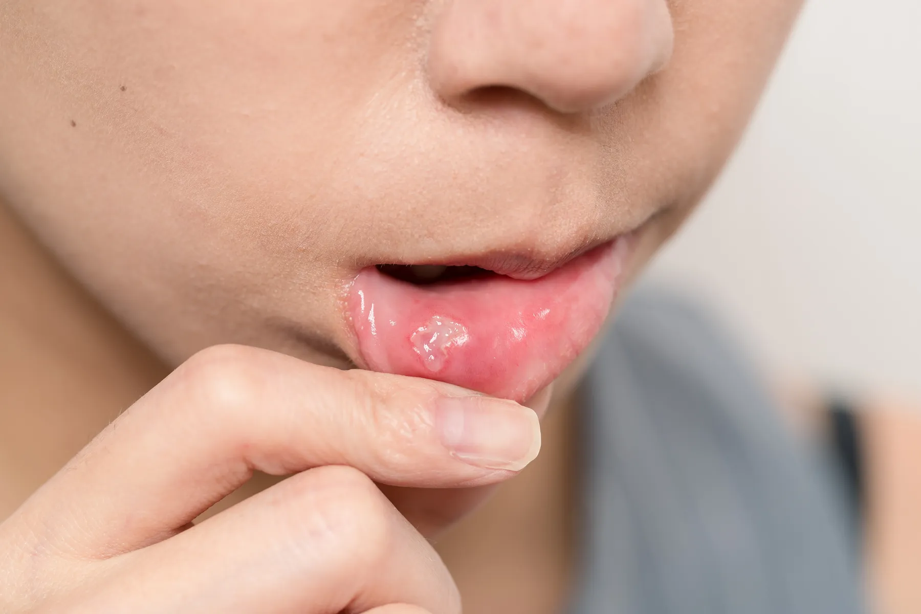 Nhiệt miệng tái đi tái lại, ăn gì cũng đau: Đây là 6 việc bạn nên làm