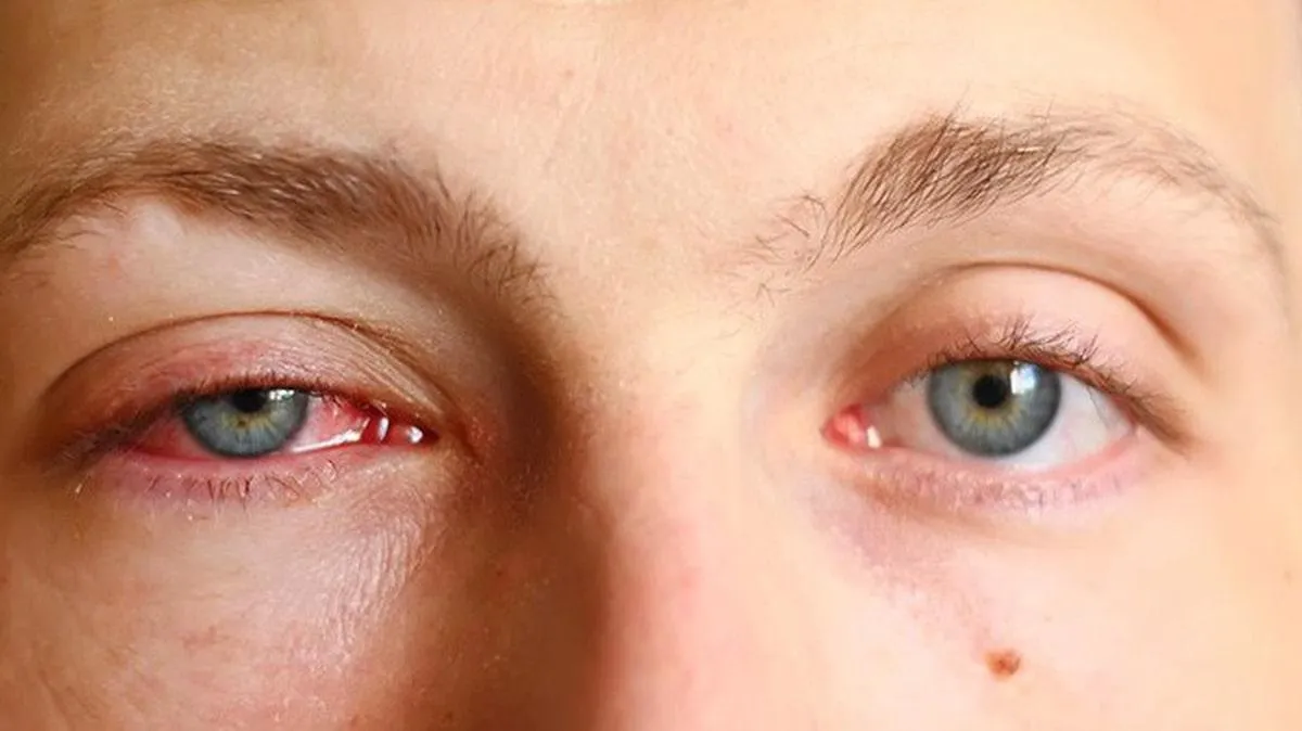 Mùa mưa, đau mắt đỏ dễ lây lan: 6 thói quen tưởng vô hại nhưng nên bỏ ngay