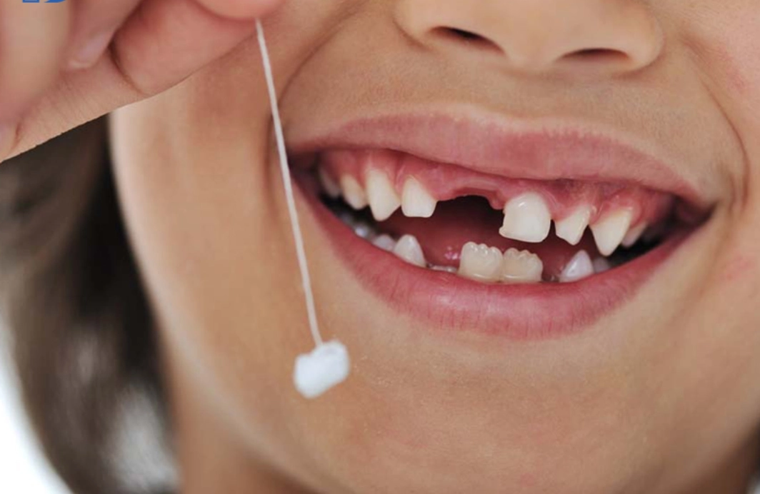Nhổ răng bằng sợi chỉ, bé trai 7 tuổi suy hô hấp, xẹp phổi