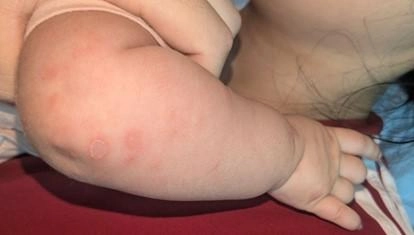 Bé 2 tháng tuổi mắc giang mai bẩm sinh, cảnh báo nguy cơ bỏ sót bệnh từ thai kỳ