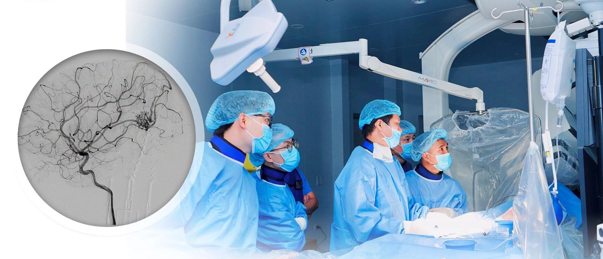 Nghệ An cứu sống hai trẻ vỡ dị dạng mạch máu não